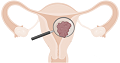 Endometrial Cancer